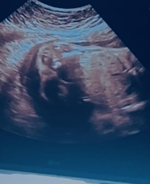 Bild zu Mädchen oder Junge 26 ssw - Schwanger - wer noch? Rund um die Schwangerschaft