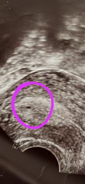 Bild zu Test „weiter“ als Ultraschall? – Erfahrungen gesucht - Schwanger - wer noch? Rund um die Schwangerschaft