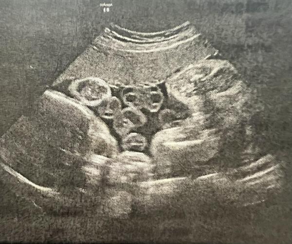 Bild zu 29+3 Mädchen oder Junge - Schwanger - wer noch? Rund um die Schwangerschaft