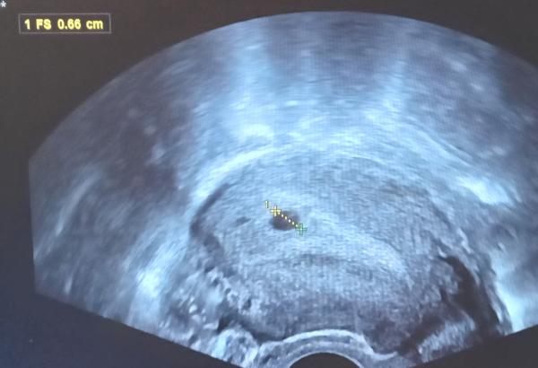 Bild zu Fehlgeburtsdiagnose - Schwanger - wer noch? Rund um die Schwangerschaft