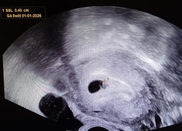 Bild zu Fehlgeburtsdiagnose - Schwanger - wer noch? Rund um die Schwangerschaft