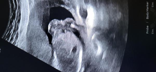 Bild zu Nabelschnur oder Penis - Schwanger - wer noch? Rund um die Schwangerschaft