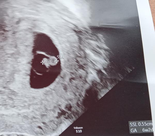 Bild zu Fehlgeburtsdiagnose - Schwanger - wer noch? Rund um die Schwangerschaft