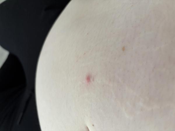 Bild zu Pickel am Bauch - Schwanger - wer noch? Rund um die Schwangerschaft