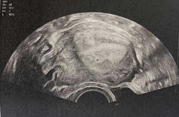 Bild zu Ultraschallbild anders als erwartet - Schwanger - wer noch? Rund um die Schwangerschaft