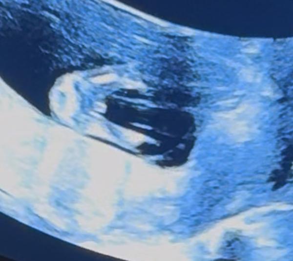Bild zu Junge oder Mädchen – was denkt ihr? 😊 - Schwanger - wer noch? Rund um die Schwangerschaft