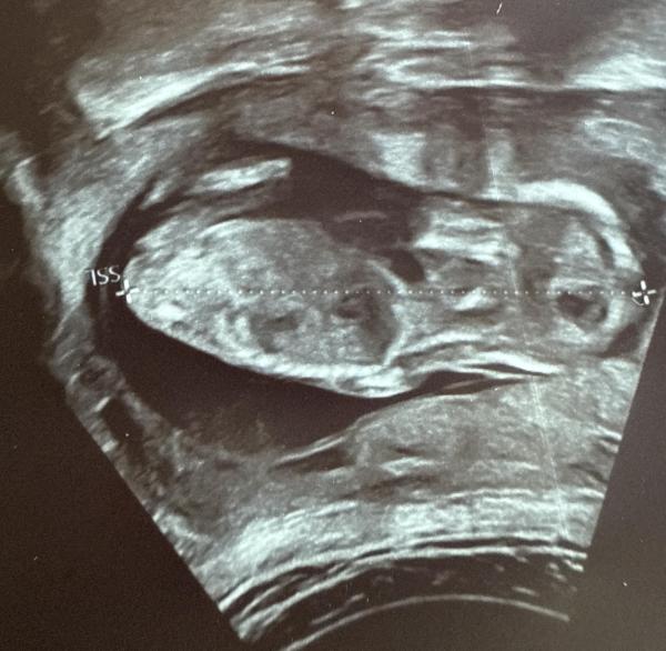 Bild zu Mädchen oder Junge ? ☺️ hat jmd. Erfahrung - Schwanger - wer noch? Rund um die Schwangerschaft