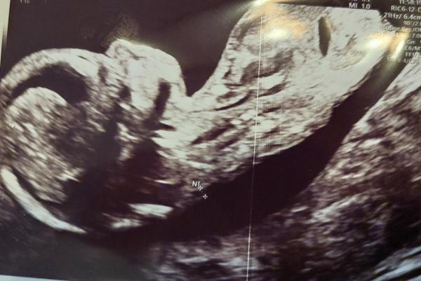 Bild zu 12+2 SSW Darstellung der Nase - Schwanger - wer noch? Rund um die Schwangerschaft