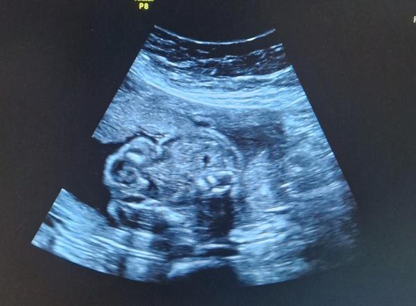 Bild zu Girl or Boy?💕🩵 - Schwanger - wer noch? Rund um die Schwangerschaft