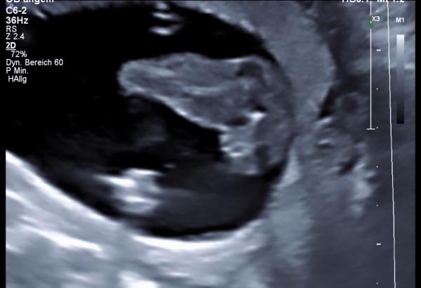 Bild zu Junge oder Mädchen 19.SSW - Schwanger - wer noch? Rund um die Schwangerschaft
