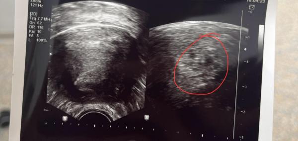 Bild zu Ultraschall 4+6 - Schwanger - wer noch? Rund um die Schwangerschaft