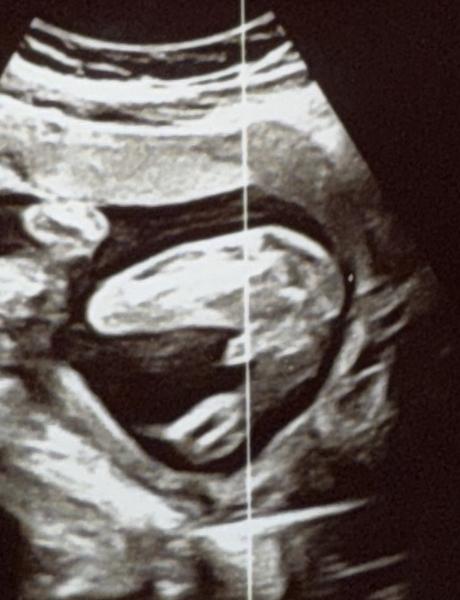 Bild zu Junge oder doch jetzt ein Mädchen? - Schwanger - wer noch? Rund um die Schwangerschaft