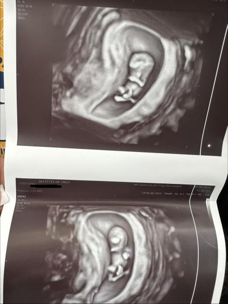 Bild zu Ultraschallbilder und SSL 10+0…. - Schwanger - wer noch? Rund um die Schwangerschaft