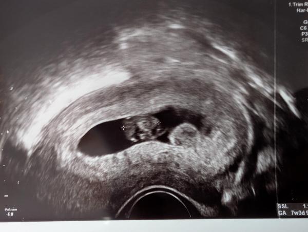 Bild zu Ultraschall 8.SSW neben Embryo weitere Wölbung Plazenta bipartita? - Schwanger - wer noch? Rund um die Schwangerschaft