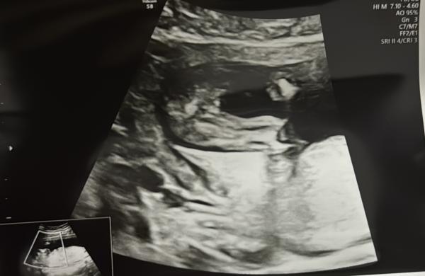 Bild zu Mädchen oder Junge - Schwanger - wer noch? Rund um die Schwangerschaft