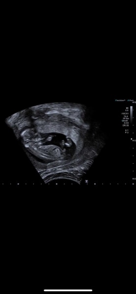 Bild zu Mädchen oder Junge? :-) - Schwanger - wer noch? Rund um die Schwangerschaft