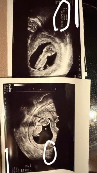 Bild zu 12 SSW - Größe Baby - Schwanger - wer noch? Rund um die Schwangerschaft