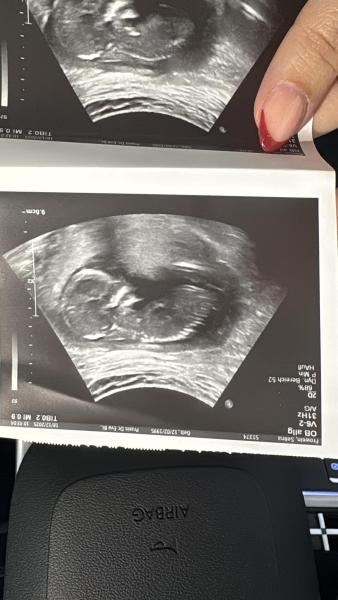 Bild zu NUB Theorie- was meint ihr? - Schwanger - wer noch? Rund um die Schwangerschaft