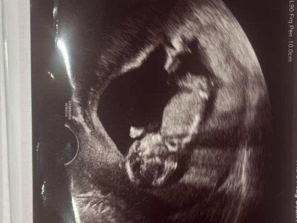 Bild zu Nub-Theorie Experten: Mädchen oder Junge? - Schwanger - wer noch? Rund um die Schwangerschaft