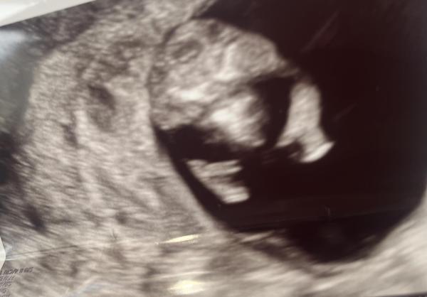 Bild zu Geschlecht erkennen in der 11ssw - Schwanger - wer noch? Rund um die Schwangerschaft