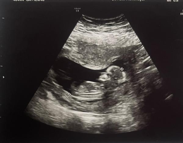 Bild zu Wer hat Ahnung von der Nub Theorie - Schwanger - wer noch? Rund um die Schwangerschaft