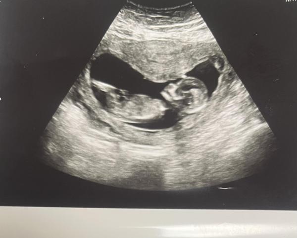 Bild zu Wer hat Ahnung von der Nub Theorie - Schwanger - wer noch? Rund um die Schwangerschaft