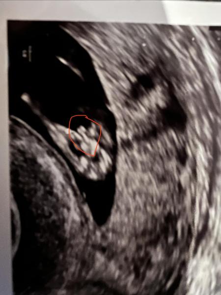 Bild zu Frühes Jungen Outing in 11+4 - Schwanger - wer noch? Rund um die Schwangerschaft