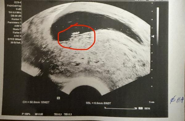 Bild zu SSW 9 Fruchthöhle leer, SSW 10 man sieht etwas - Schwanger - wer noch? Rund um die Schwangerschaft