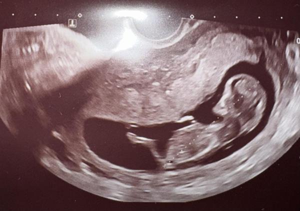 Bild zu 🧸💙Junge oder Mädchen🧸🩷 was schätzt ihr? - Schwanger - wer noch? Rund um die Schwangerschaft