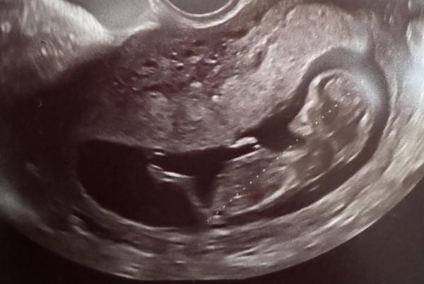 Bild zu 🧸💙Junge oder Mädchen🧸🩷 was schätzt ihr? - Schwanger - wer noch? Rund um die Schwangerschaft