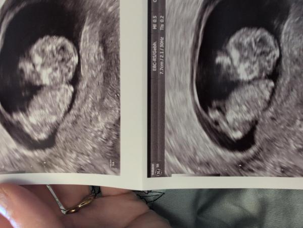 Bild zu Nub - Schwanger - wer noch? Rund um die Schwangerschaft