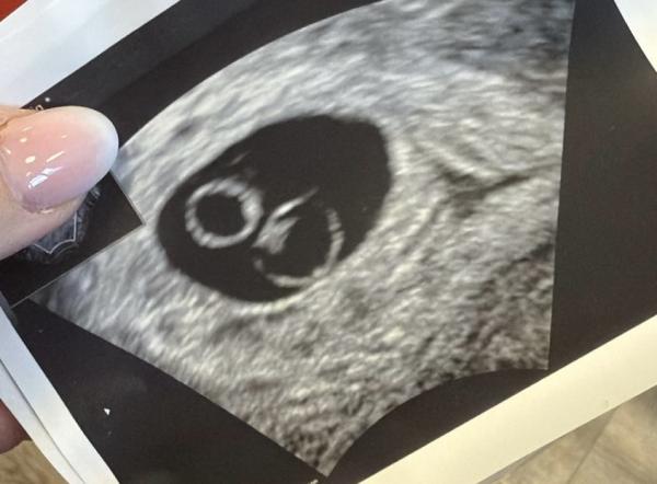 Bild zu Zwillinge? Jemand Erfahrung? - Schwanger - wer noch? Rund um die Schwangerschaft