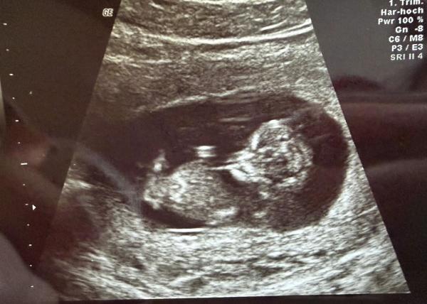 Bild zu Junge oder Mädchen ? - Schwanger - wer noch? Rund um die Schwangerschaft