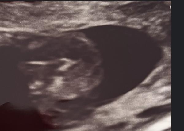 Bild zu Mädchen oder Junge? Was meint ihr 😀 - Schwanger - wer noch? Rund um die Schwangerschaft