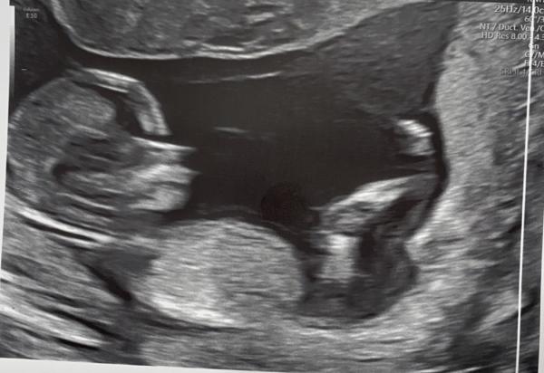 Bild zu Junge oder Mädchen, kann jemand helfen? - Schwanger - wer noch? Rund um die Schwangerschaft