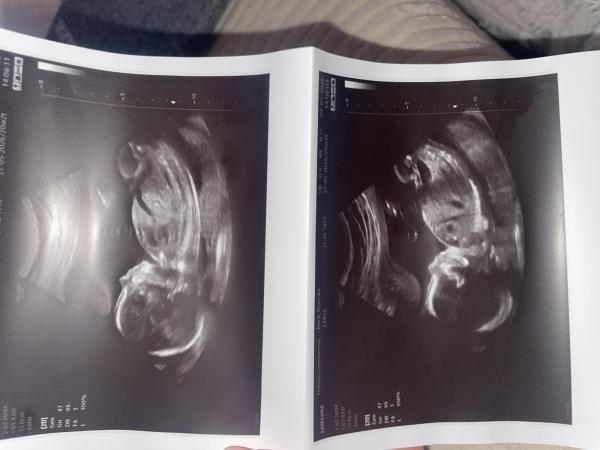 Bild zu Geschlechtserkennung - Schwanger - wer noch? Rund um die Schwangerschaft