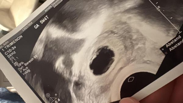 Bild zu 5+4 ssw nur fruchthöhle hcg relativ hoch - Schwanger - wer noch? Rund um die Schwangerschaft