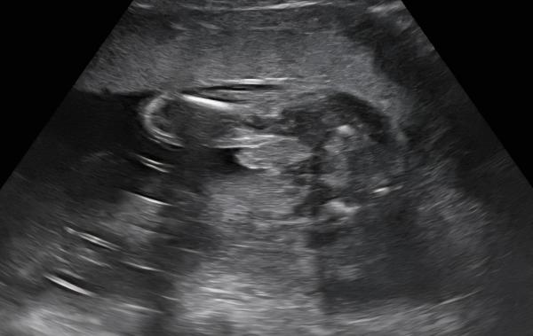 Bild zu Geschlecht im Ultraschall - Schwanger - wer noch? Rund um die Schwangerschaft