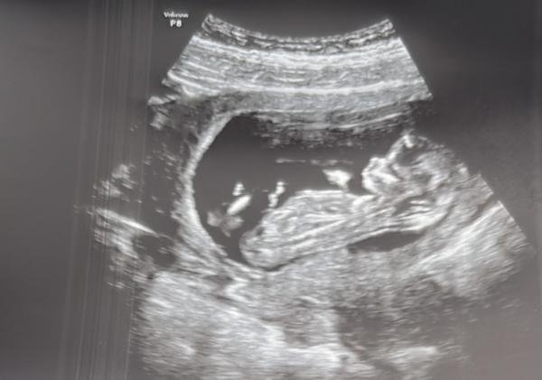 Bild zu Mädchen oder Junge? Erkennt jemand was? - Schwanger - wer noch? Rund um die Schwangerschaft