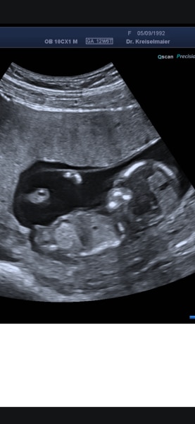 Bild zu Mädchen oder Junge? Erkennt jemand was? - Schwanger - wer noch? Rund um die Schwangerschaft