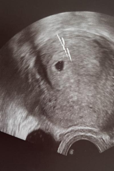 Bild zu Nur Fruchthöhle an SSW 5+3 - Schwanger - wer noch? Rund um die Schwangerschaft