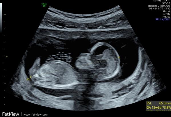 Bild zu Mädchen oder Junge? - Schwanger - wer noch? Rund um die Schwangerschaft