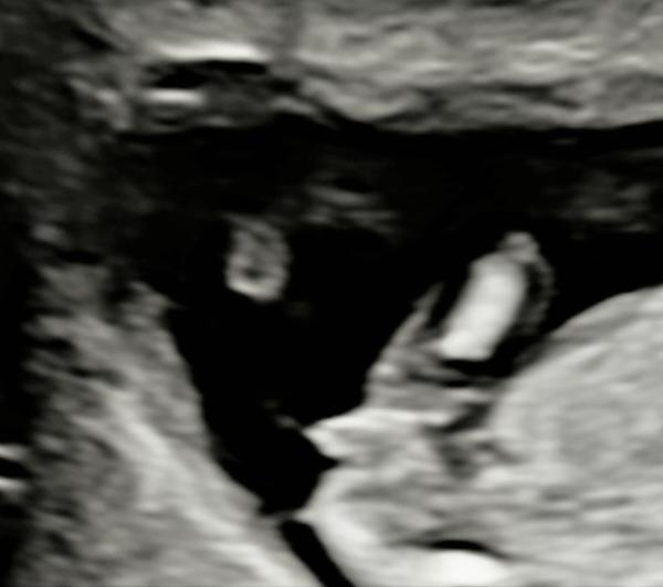 Bild zu Mädchen oder Junge? - Schwanger - wer noch? Rund um die Schwangerschaft