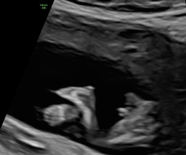 Bild zu Mädchen oder Junge? - Schwanger - wer noch? Rund um die Schwangerschaft