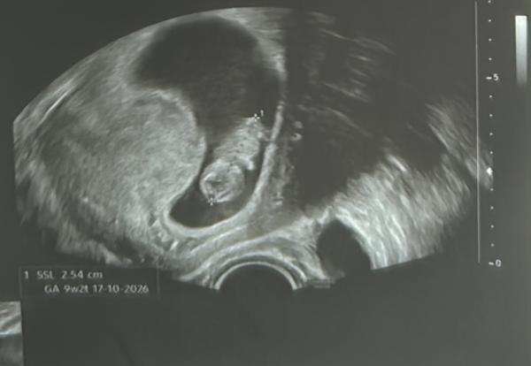 Bild zu Ramzi und nub Theorie. Kennst sich jemand aus ? - Schwanger - wer noch? Rund um die Schwangerschaft