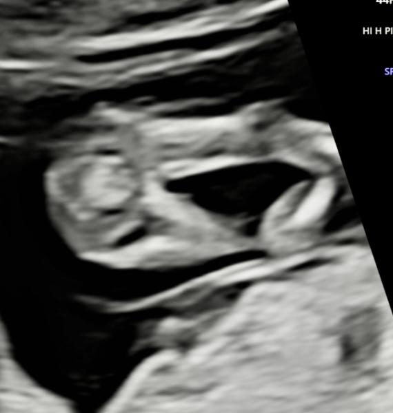 Bild zu Mädchen oder Junge? - Schwanger - wer noch? Rund um die Schwangerschaft