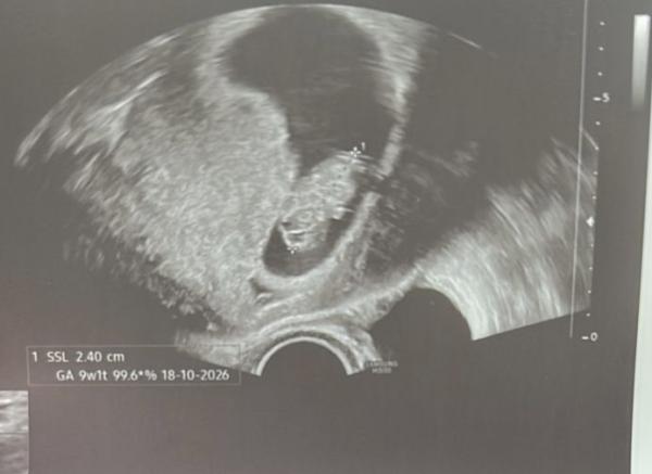 Bild zu Ramzi und nub Theorie. Kennst sich jemand aus ? - Schwanger - wer noch? Rund um die Schwangerschaft