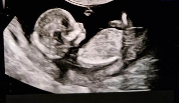 Bild zu Junge oder Mädchen - Schwanger - wer noch? Rund um die Schwangerschaft