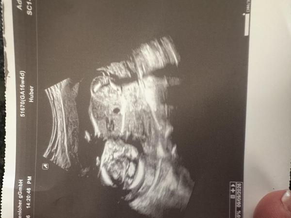 Bild zu Mädchen oder Junge 17ssw - Schwanger - wer noch? Rund um die Schwangerschaft