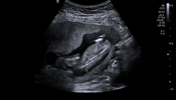 Bild zu Vermutungen Jung oder Mädchen ? - Schwanger - wer noch? Rund um die Schwangerschaft